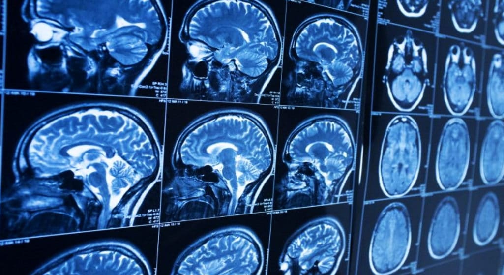Σύστημα τεχνητής νοημοσύνης που εκπαιδεύτηκε με απεικονιστικές εξετάσεις χιλιάδων ασθενών βελτιώνει την ακρίβεια της χαρτογράφησης όγκων στον εγκέφαλο, αναφέρει η μεγάλη ερευνητική ομάδα που το δοκίμασε, στην οποία περιλαμβάνονται και ερευνητές του Πανεπιστημίου Πατρών.