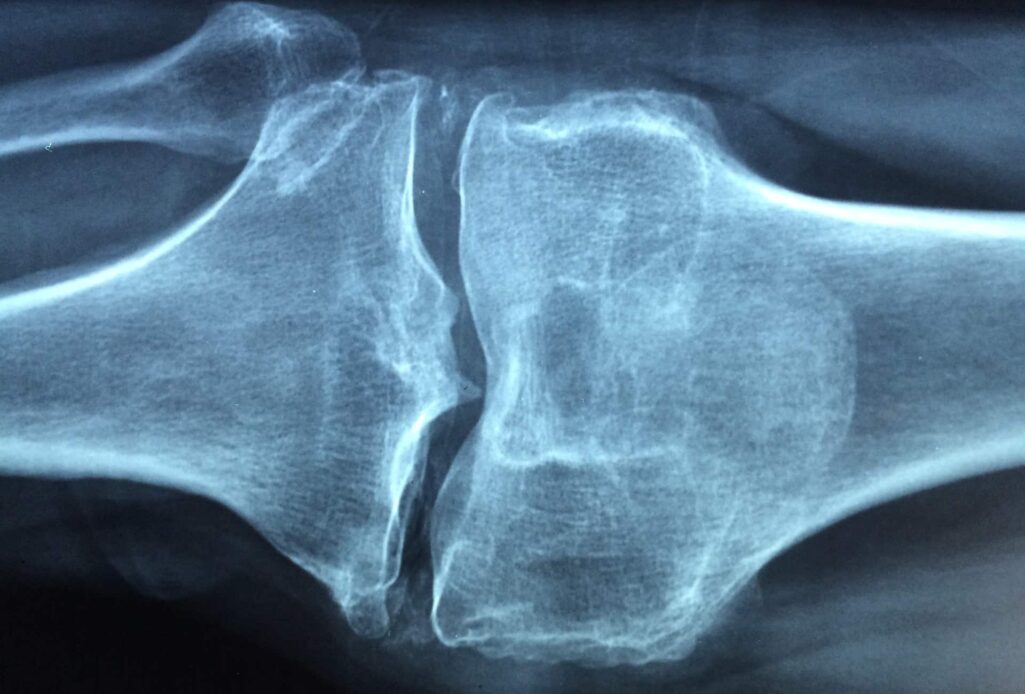 Η οστεοπόρωση είναι μια εκφυλιστική νόσος των οστών η οποία «χτυπά» κυρίως τις μετεμμηνοπαυσιακές γυναίκες.