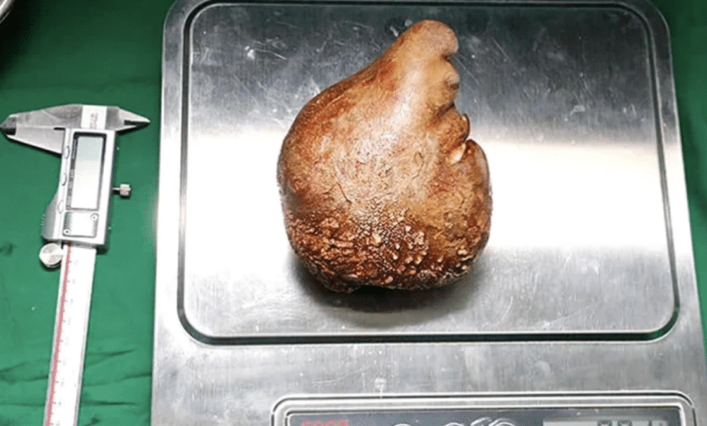 Πέτρα για ρεκόρ Γκίνες είναι αυτή που αφαιρέθηκε από τους νεφρούς ασθενή στην Σρι Λάνκα καθώς πρόκειται για την μεγαλύτερη που έχει βρεθεί μέχρι σήμερα και θυμίζει μπάλα του μπέιζμπολ