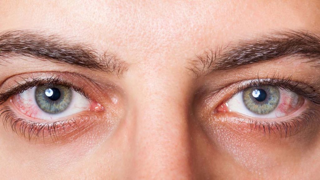 Η ευλογιά των πιθήκων μπορεί να προκαλέσει οφθαλμολογικά προβλήματα, που κυμαίνονται από φλεγμονή στην επιφάνειά τους (επιπεφυκίτιδα) έως απώλεια όρασης λόγω εξέλκωσης του κερατοειδούς χιτώνα, προειδοποιεί η Αμερικανική Ακαδημία Οφθαλμολογίας (American Academy of Ophthalmology - AAO).