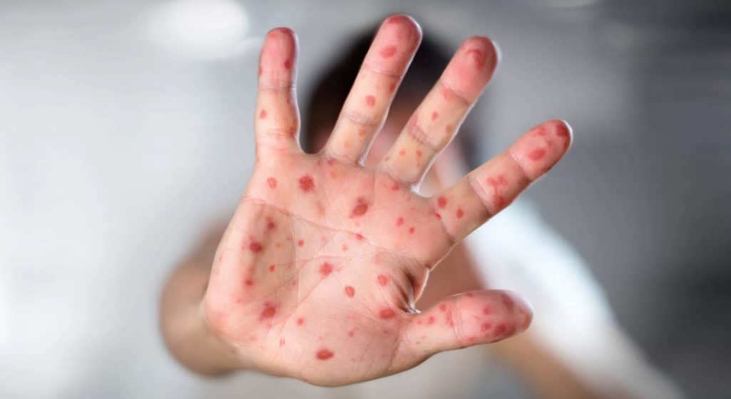 Συναγερμός έχει σημάνει σε πόλεις της Αγγλίας για έξαρση της ιλαράς σε παιδιά μετά τη μεγάλη αύξηση των κρουσμάτων.