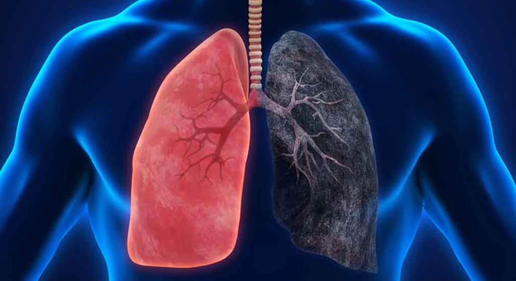 Η πανδημία COVID-19 είχε βαθύ αντίκτυπο στους ασθενείς, συμπεριλαμβανομένων εκείνων που ζουν με καρκίνο του πνεύμονα, και στα συστήματα υγειονομικής περίθαλψης σε όλο τον κόσμο.