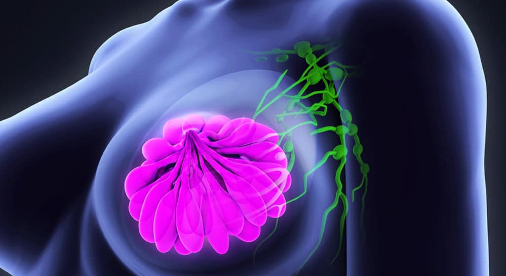 Νέα θεραπευτική αντιμετώπιση του προχωρημένου “HER2-low” καρκίνου του μαστού, σύμφωνα με μελέτη στην οποία συμμετέχει η Ελληνίδα καθηγήτρια Φλώρα Ζαγουρή.