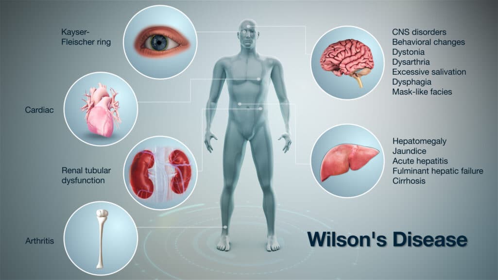 Η νόσος του Wilson είναι μια γενετική διαταραχή στην οποία το σώμα δεν απορροφά χαλκό, οπότε ο χαλκός συσσωρεύεται στους ιστούς του σώματος, στο συκώτι, στον εγκέφαλο και άλλα ζωτικά όργανα