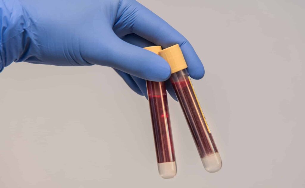 Ένα νέο τεστ αίματος ανέπτυξαν επιστήμονες στις ΗΠΑ που χρησιμοποιεί τεχνητή νοημοσύνη για να ανιχνεύσει τους καρκίνους του ήπατος σε ποσοστό άνω του 80%. Το τεστ με την ονομασία DELFI είχε το 2021 αρχικά χρησιμοποιηθεί για τη διάγνωση με επιτυχία του καρκίνου των πνευμόνων.