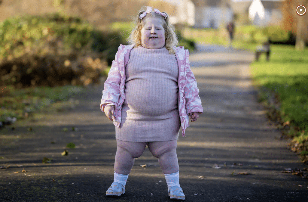 Ένα 5χρονο κορίτσι ζυγίζει σχεδόν 45 κιλά λόγω μιας σπάνιας πάθησης που την κάνει να θέλει όλο και περισσότερο φαγητό.