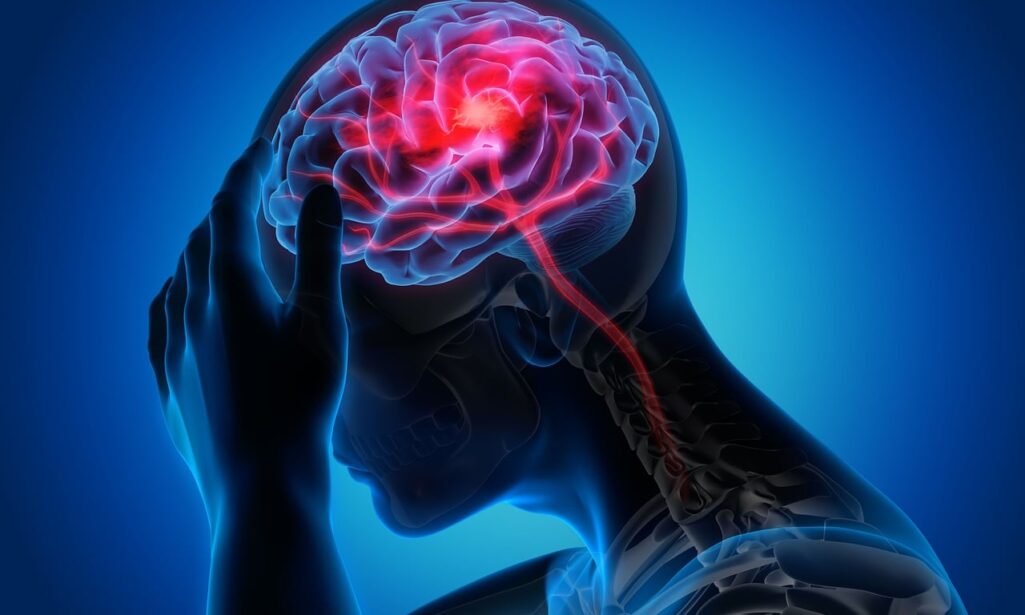 Η ημικρανία «είναι μια πολύ συγκεκριμένη νευρολογική ασθένεια, η οποία επηρεάζει σημαντικά τη ζωή των ανθρώπων που πάσχουν από αυτήν