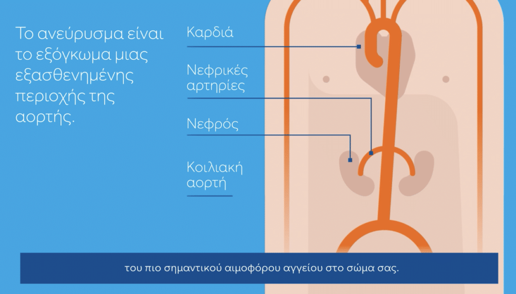 Με αφορμή τον Παγκόσμιο Μήνα Ανευρύσματος, η Ελληνική Εταιρεία Αγγειακής και Ενδαγγειακής Χειρουργικής (ΕΕΑΕΧ), διοργανώνει την Παρασκευή 11 Οκτωβρίου 2024, από τις 12:00 έως τις 19:00, ενημερωτική εκδήλωση στην Πλατεία Συντάγματος